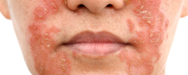 psoriasis